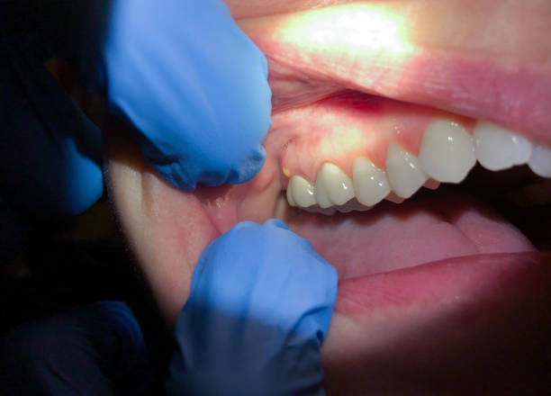 Best Chipped Tooth Repair Near Me  in Listoga, CA