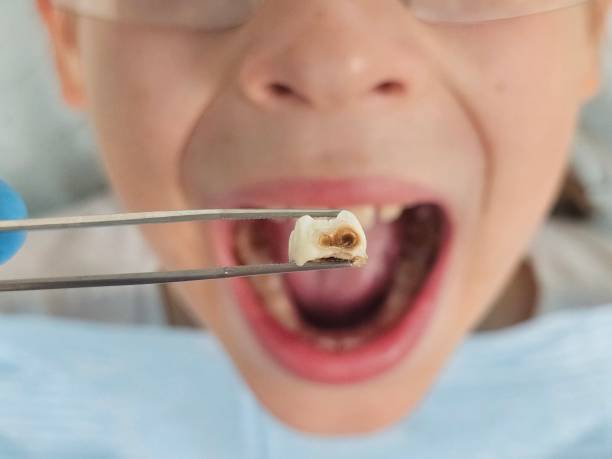 Best Teeth Whitening  in Listoga, CA